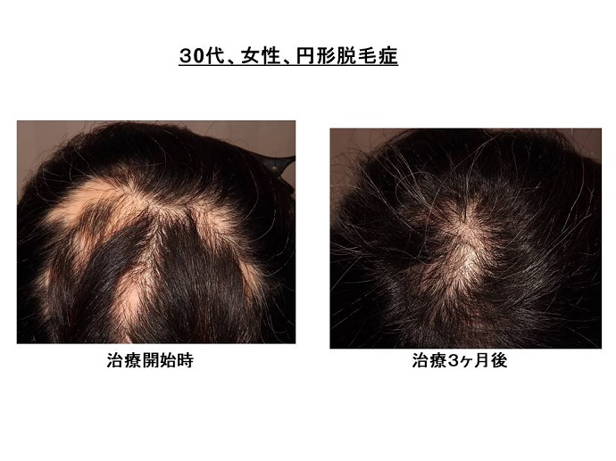 円形脱毛症　病院""